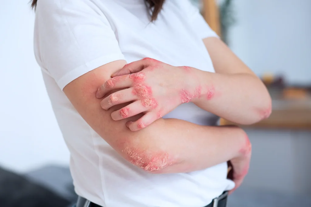 Eczema care at AgeRejuvenation