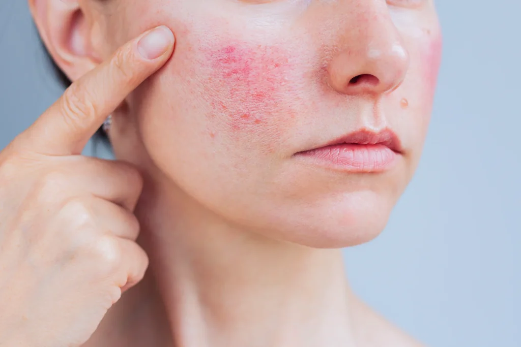 Rosacea at AgeRejuvenation
